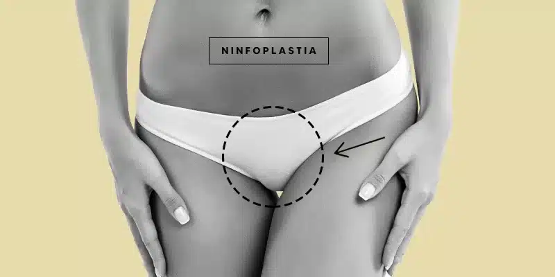 Ninfoplastia: Aumento dos Pequenos Lábios Vaginais para Mais Prazer