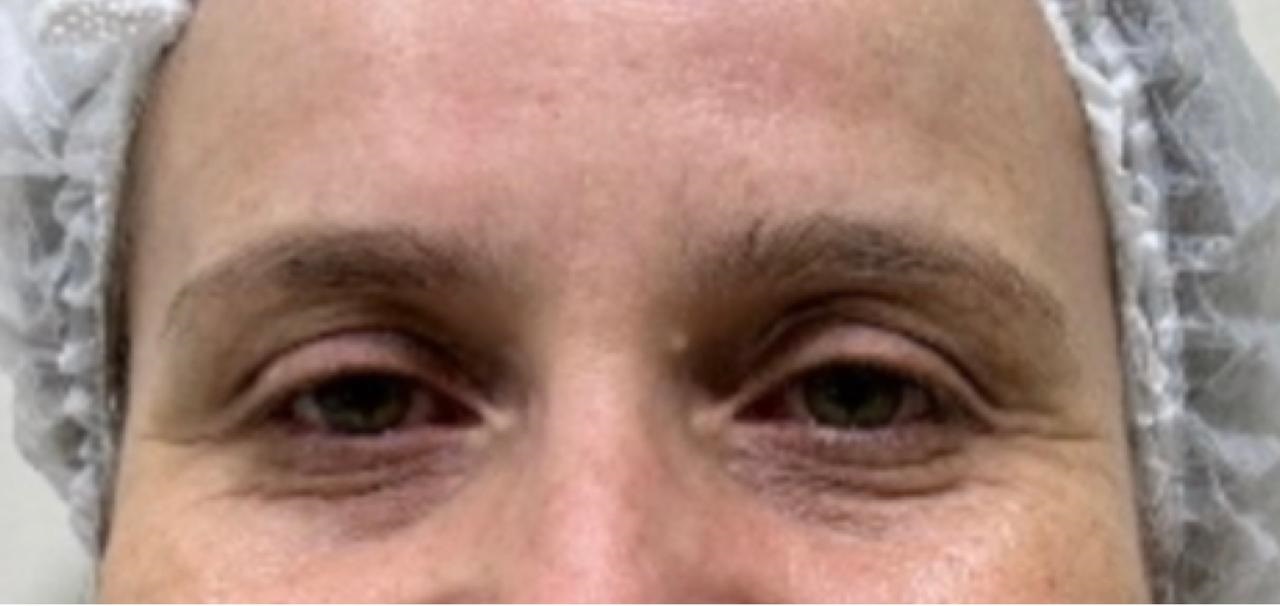 Antes do tratamento - Rejuvenescimento do olhar