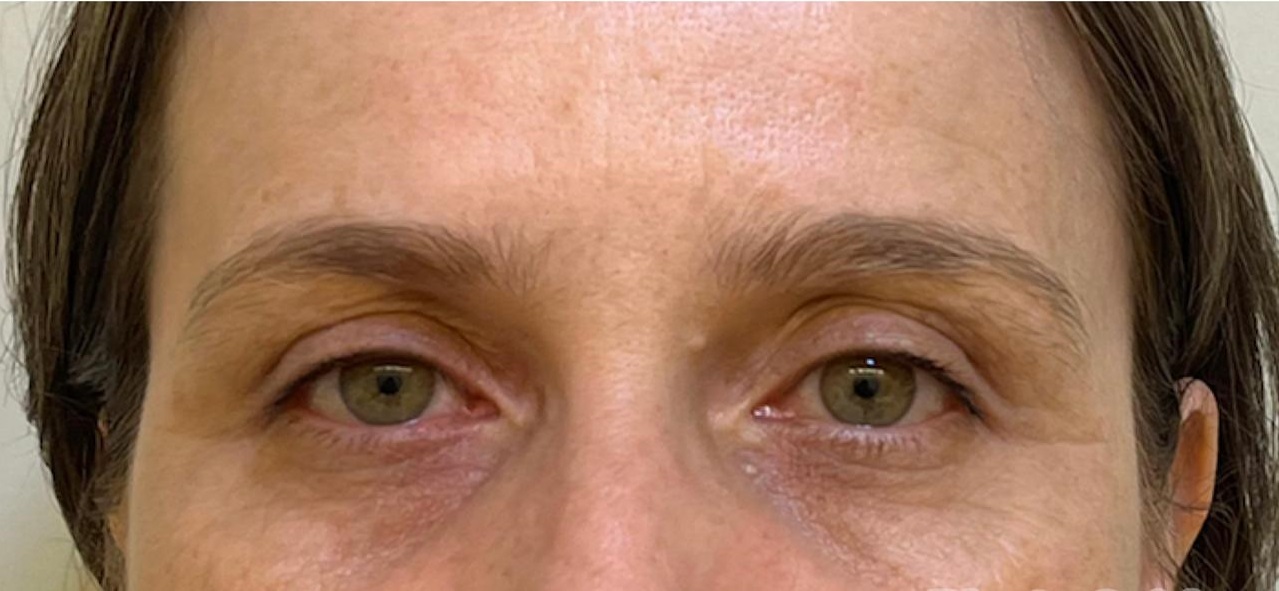Depois do tratamento - Rejuvenescimento do olhar