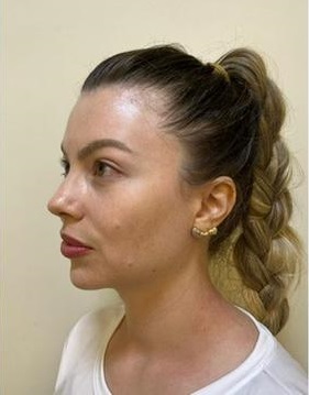 Depois do tratamento - Rejuvenescimento e emagrecimento facial