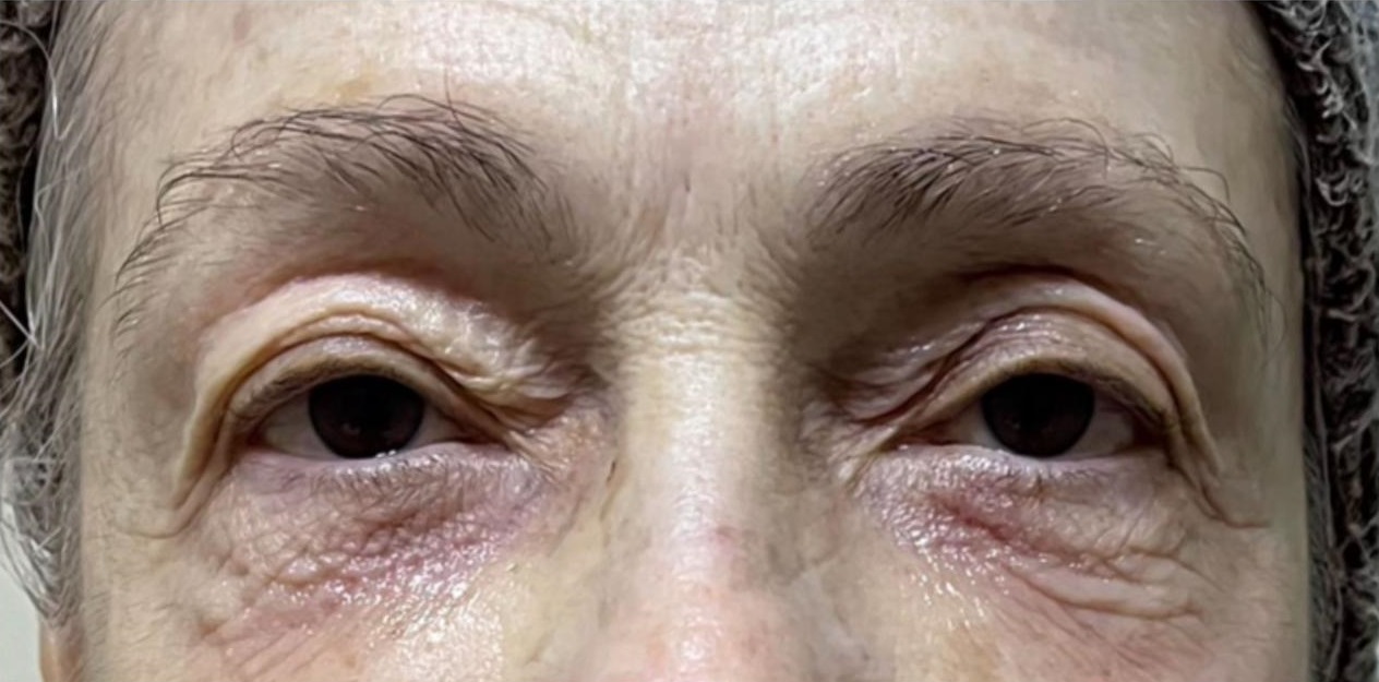 Antes do tratamento - Tightening Facial