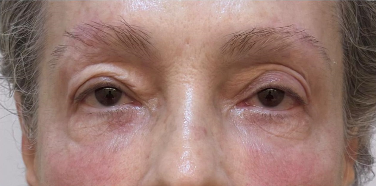 Depois do tratamento - Tightening Facial