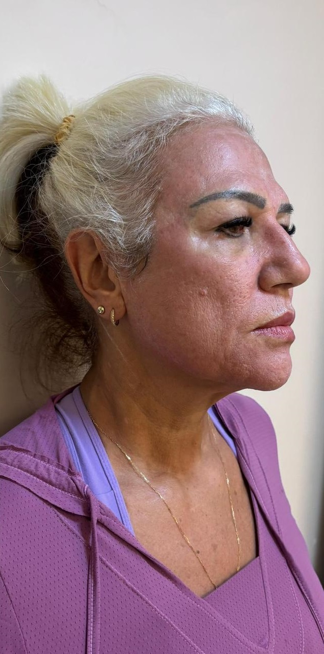 Depois do tratamento - Rejuvenescimento global