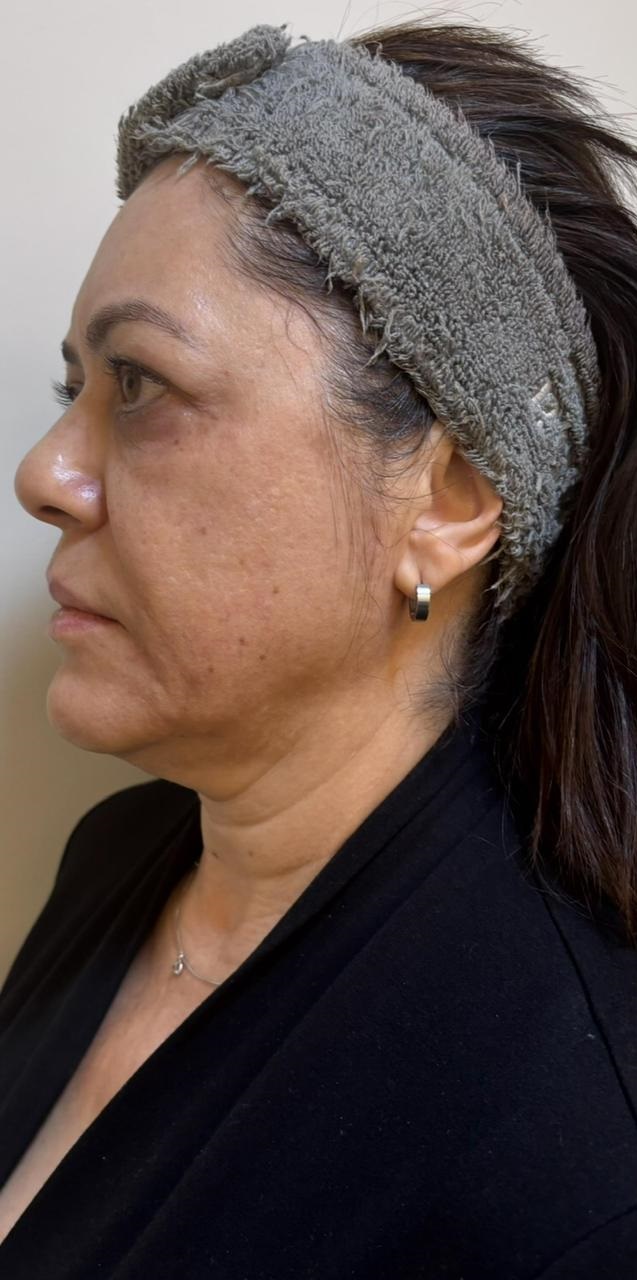 Antes do tratamento - Rejuvenescimento global facial
